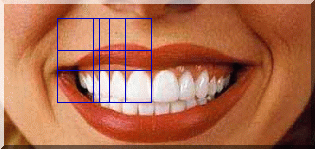 Mouth with PhiMatrix dental grid